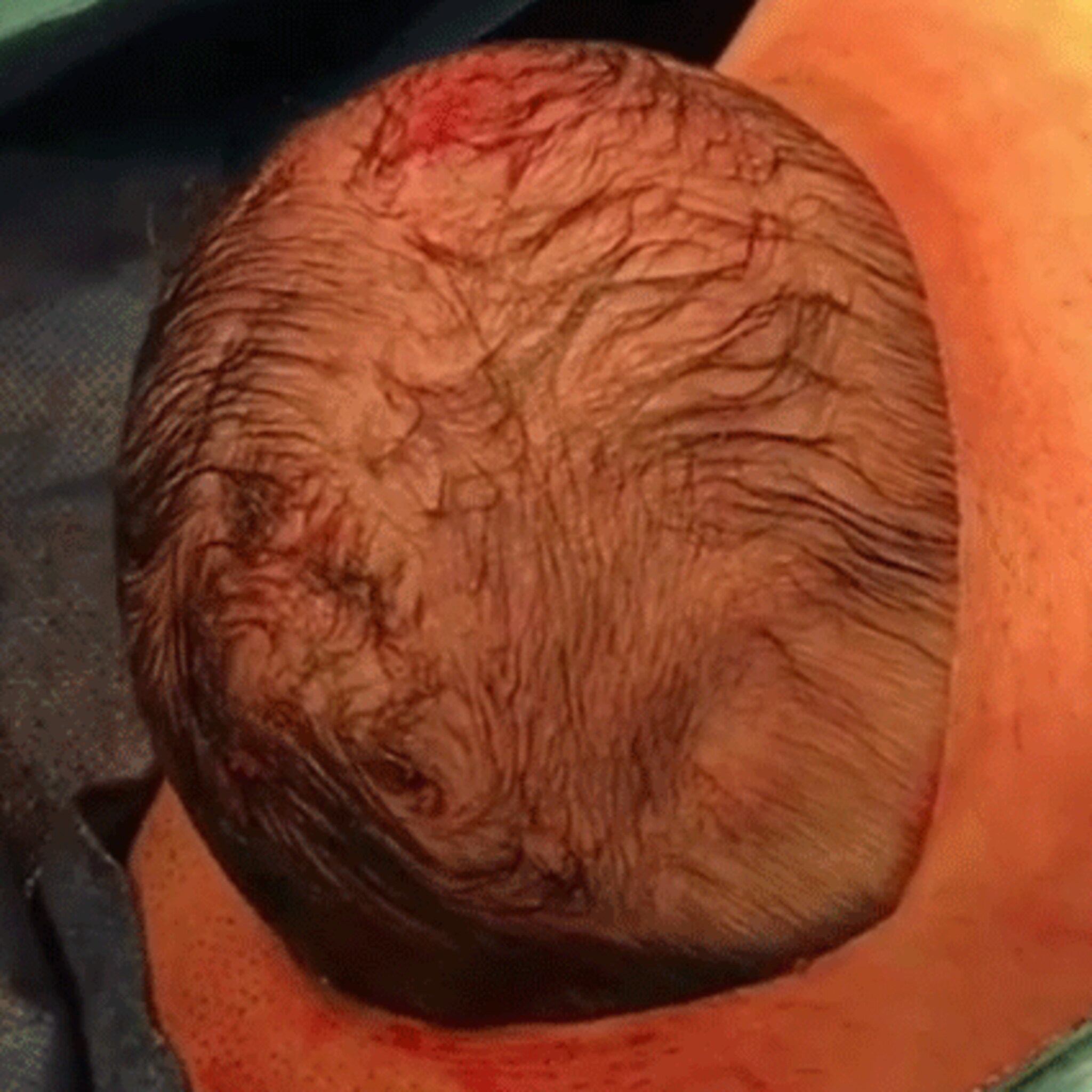 magisch moment baby plopt uit buik tijdens gentle sectio