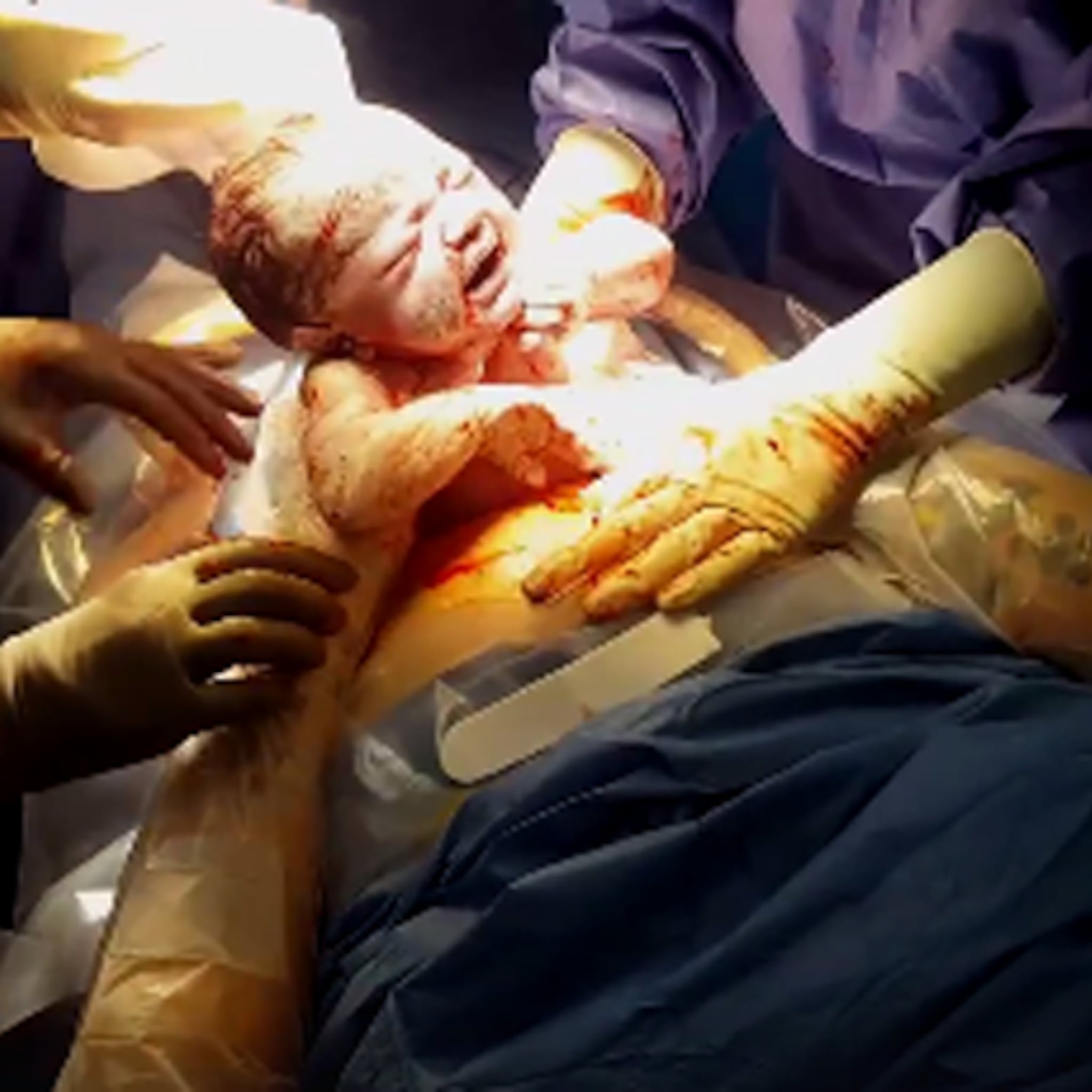mooi keizersnede waarbij moeder zelf haar baby uit haar buik haalt