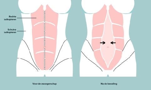 Diastase tijdens je zwangerschap en na de bevalling Ouders van Nu Redactie
