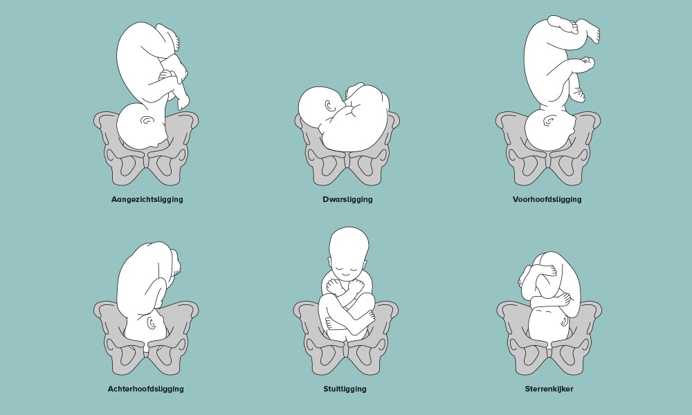Macrosomie: bevallen van een grote baby Ouders van Nu/Illustratie van verschillende soorten liggingen in de baarmoeder.