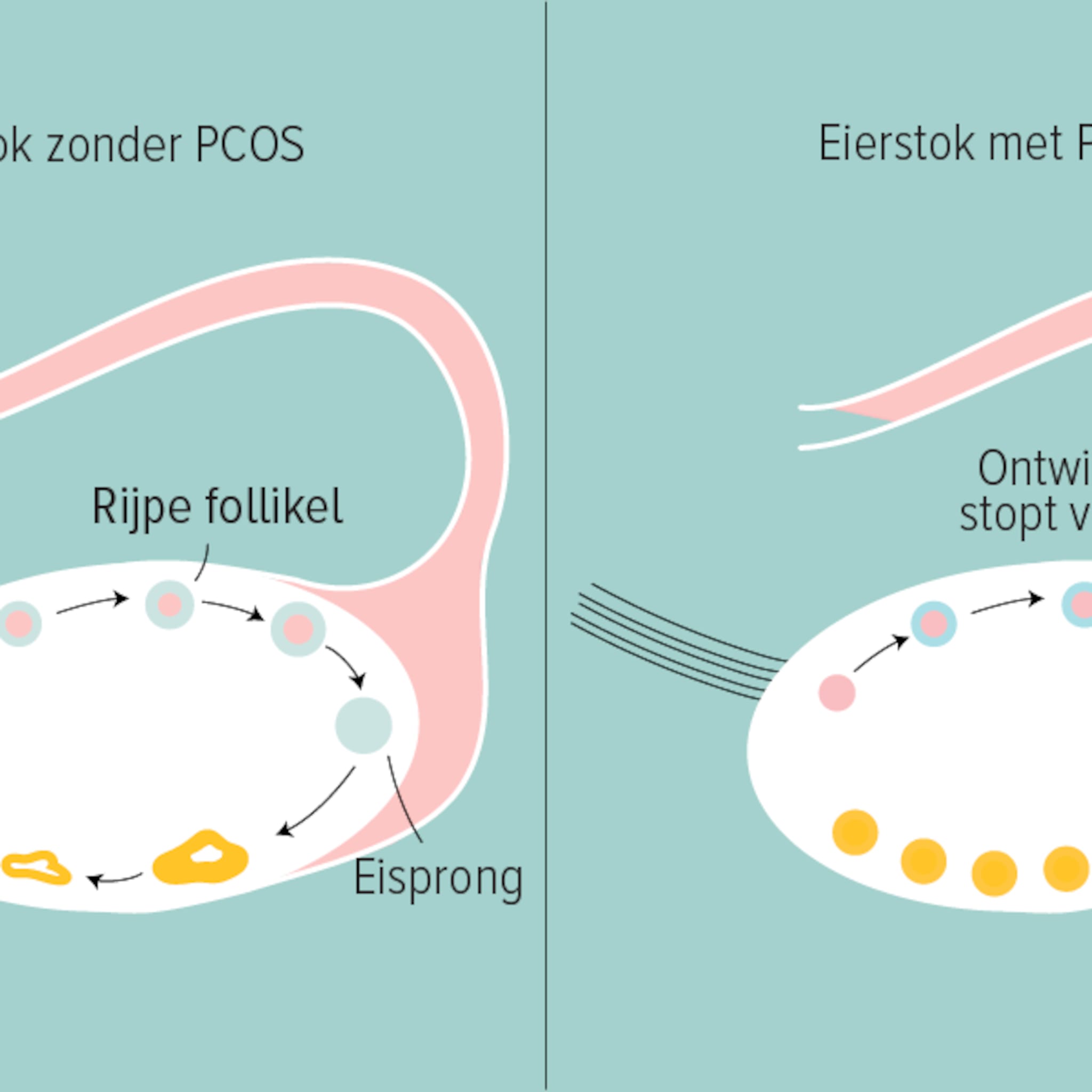pcos en zwanger worden