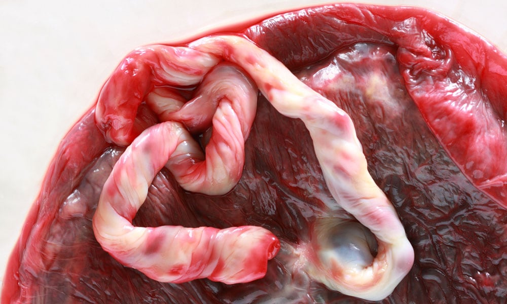 De placenta en de navelstreng na de geboorte. Getty Images