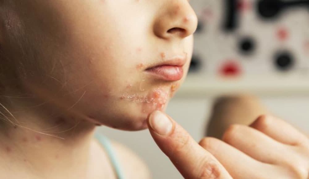 Krentenbaard bij kinderen Krentenbaard bij kind met wondjes met gele korstjes.
