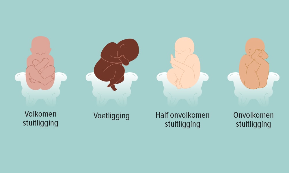 Stuitligging: draaien of niet? Ouders van Nu Redactie