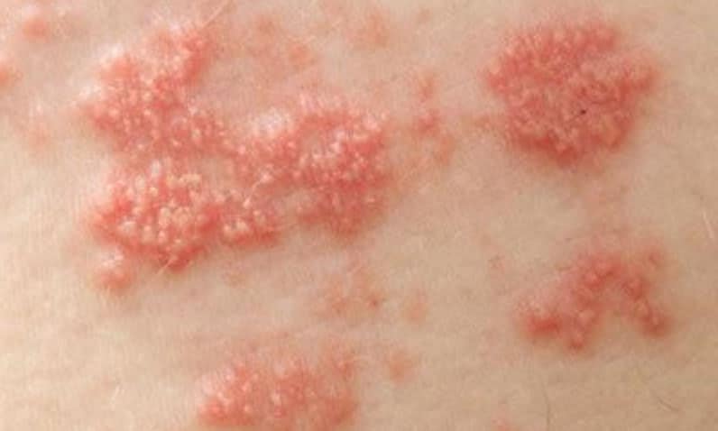 Zonneallergie bij baby’s en kinderen Getty Images