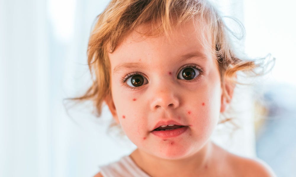 Waterpokken: alles wat je moet weten Getty Images - Dit meisje is niet meer besmettelijk, de blaasjes zijn ingedroogd.