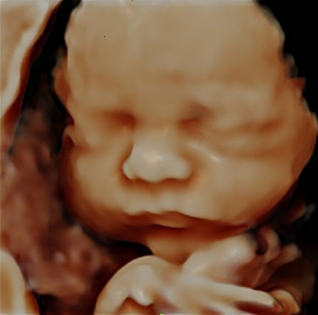 Pretecho 4D-echo 4D-pretecho, Babygrafie