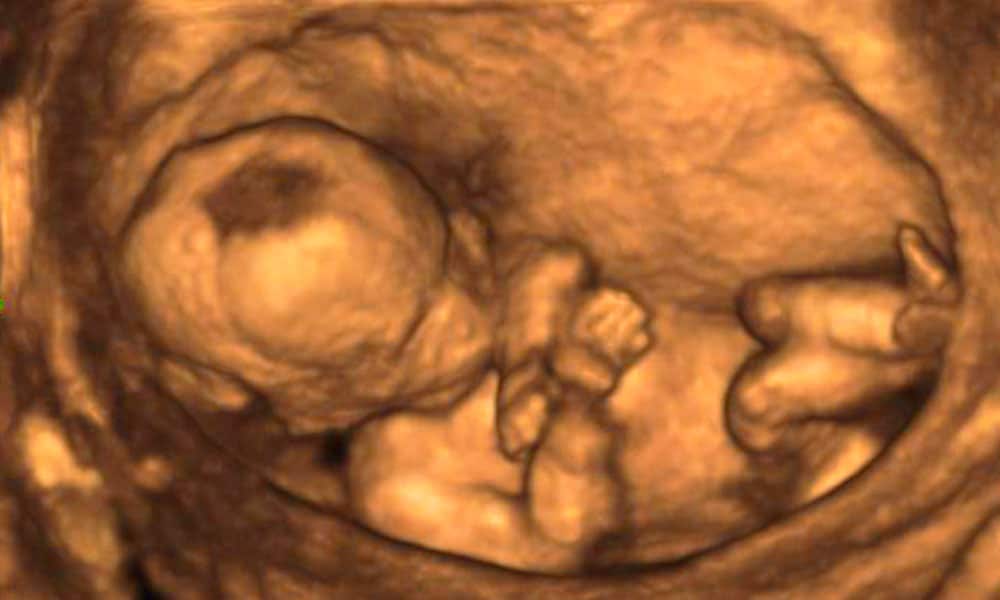 Pretecho 3D-echo 3D-pretecho, Babygrafie