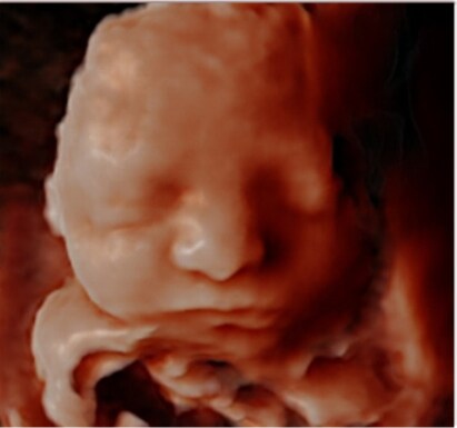 Pretecho  5D-echo 5D-pretecho, Babygrafie