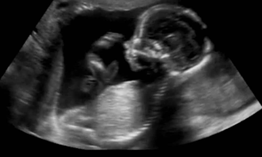 Pretecho 2D-echo 2D-pretecho, Babygrafie