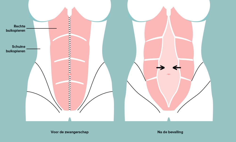 Illustratie van diastase/Ouders van Nu