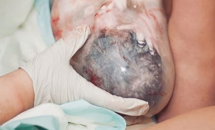 Eén op de 80.000 baby’s wordt geboren in vruchtzak Ouders van Nu Redactie