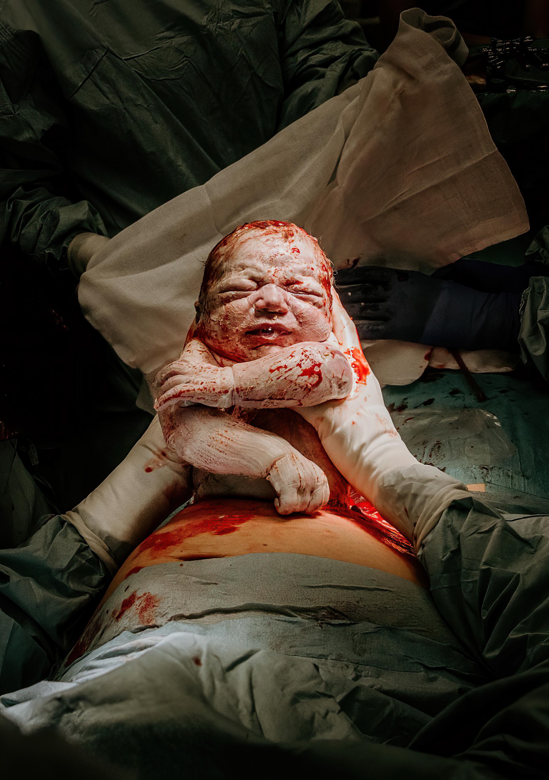 Indrukwekkend: baby Pepijn wordt door zijn moeder uit de buik getild bij een moeder-geassisteerde sectio Inge Berken