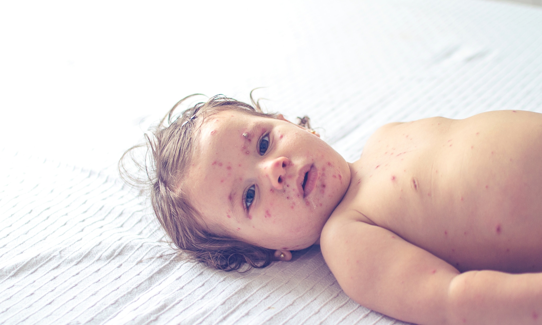 Meisje met de mazalen Getty Images