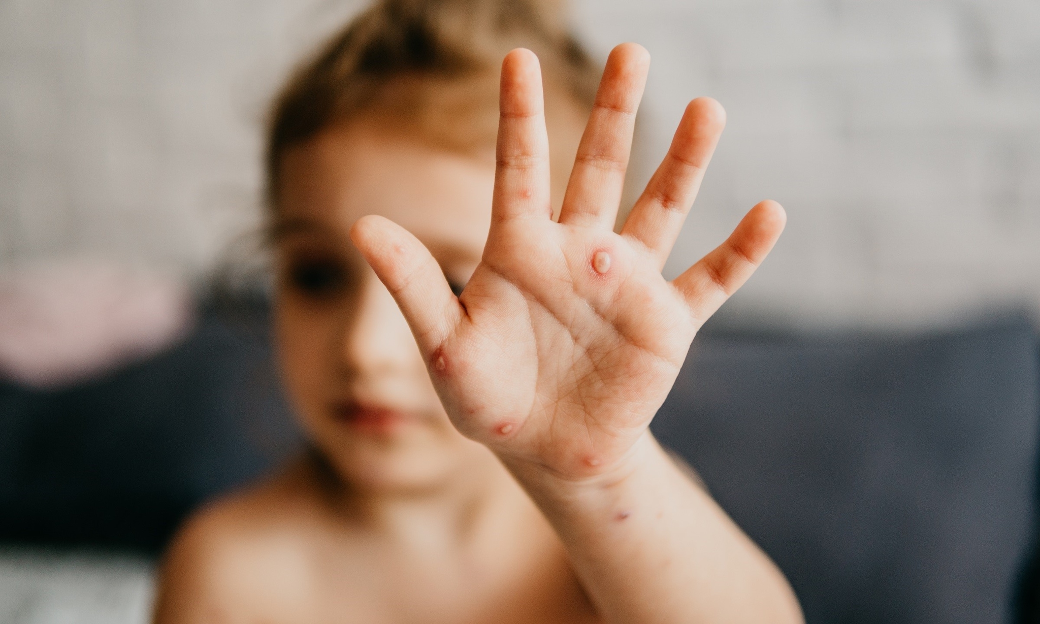 Waterpokken blaasjes op hand kind Getty Images - Bij dit kind zijn de vlekjes veranderd in blaasjes.