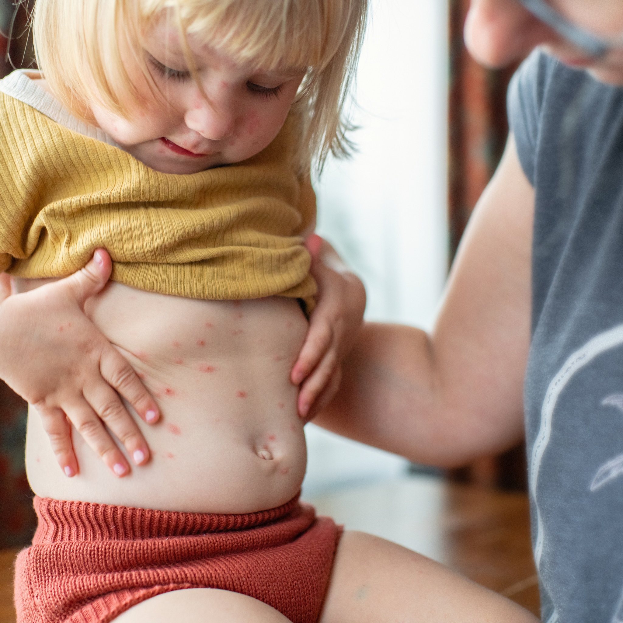 van moedermelk in bad tot nagels kort houden dit zijn tips van ouders bij waterpokken