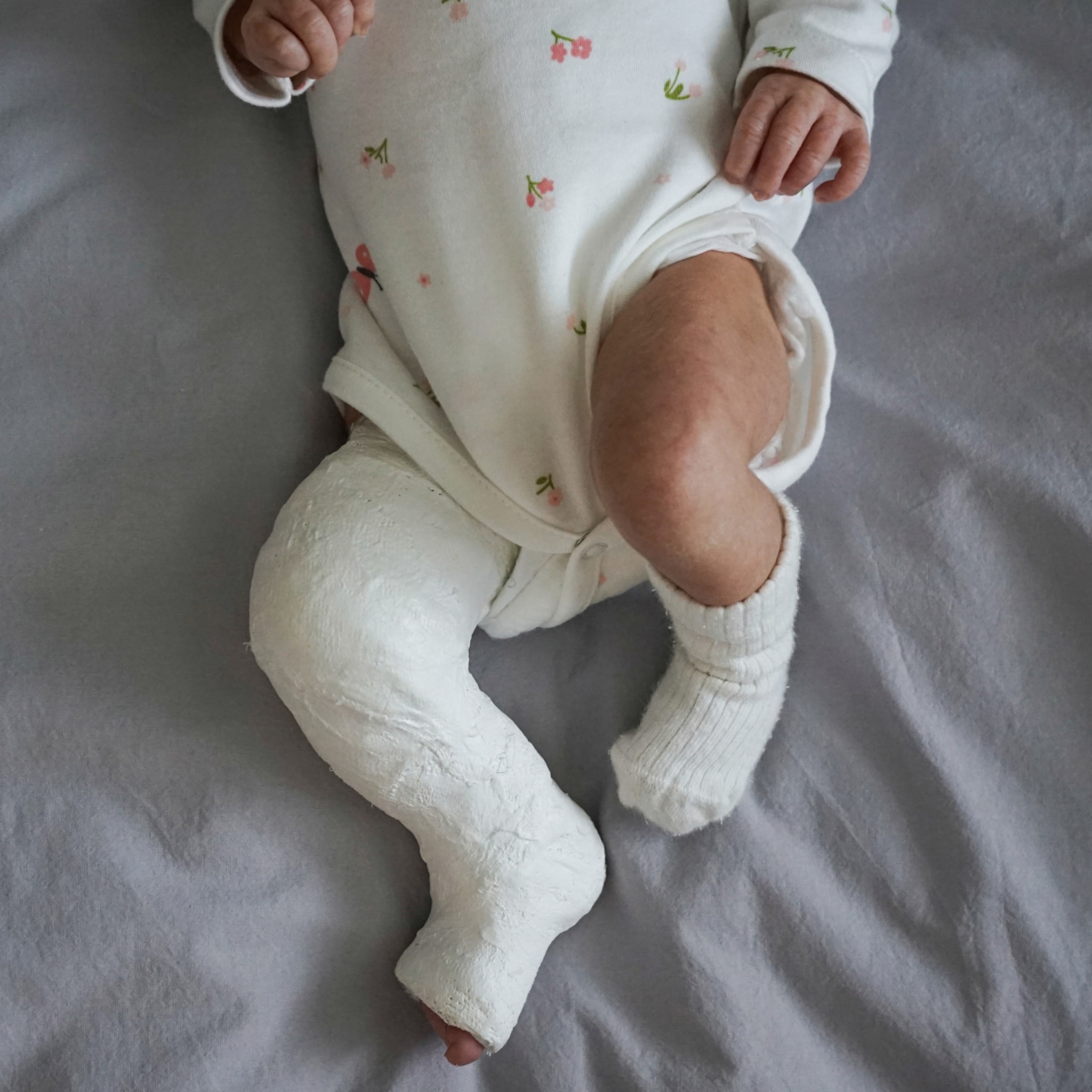 klompvoet bij je baby oorzaak en behandeling