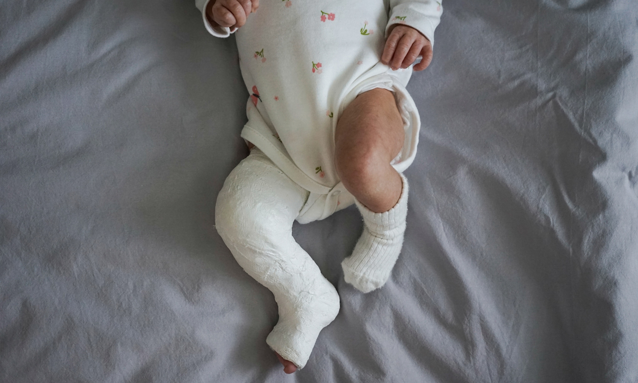Klompvoet bij je baby: oorzaak en behandeling Getty Images