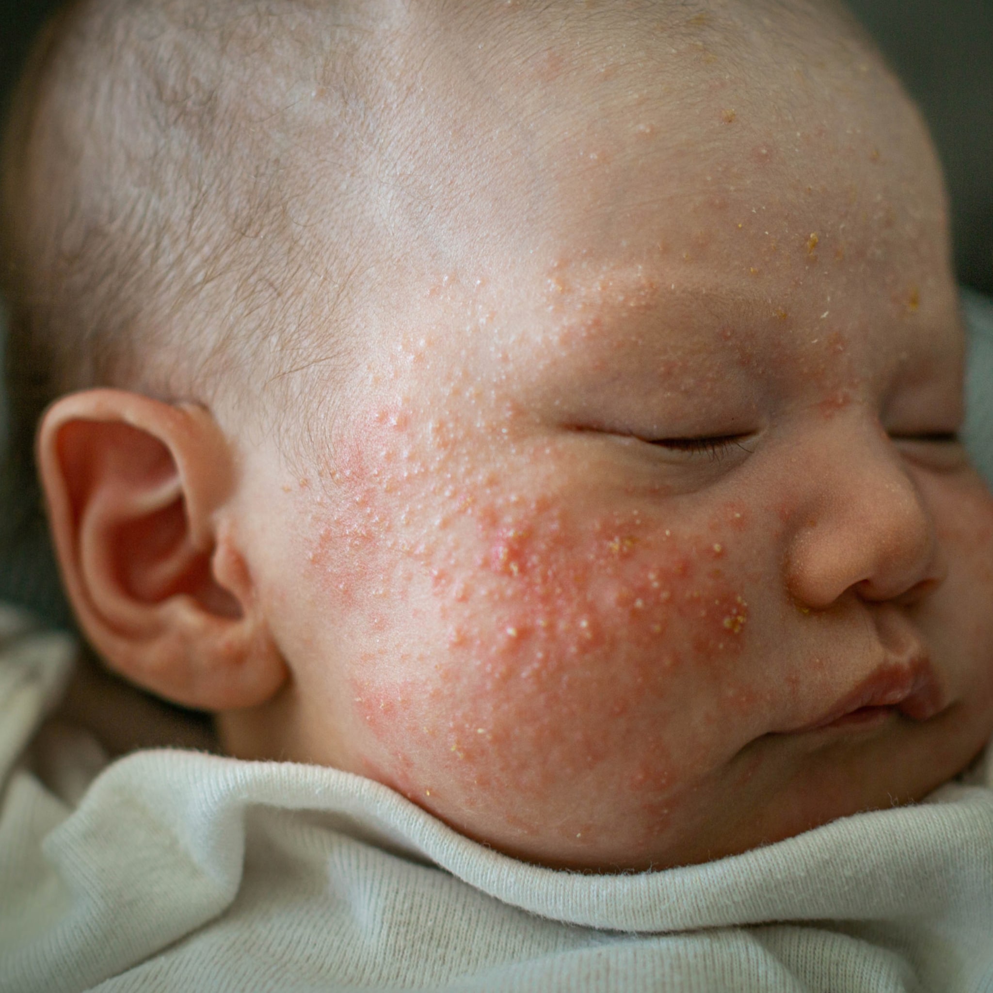 eczeem bij je baby