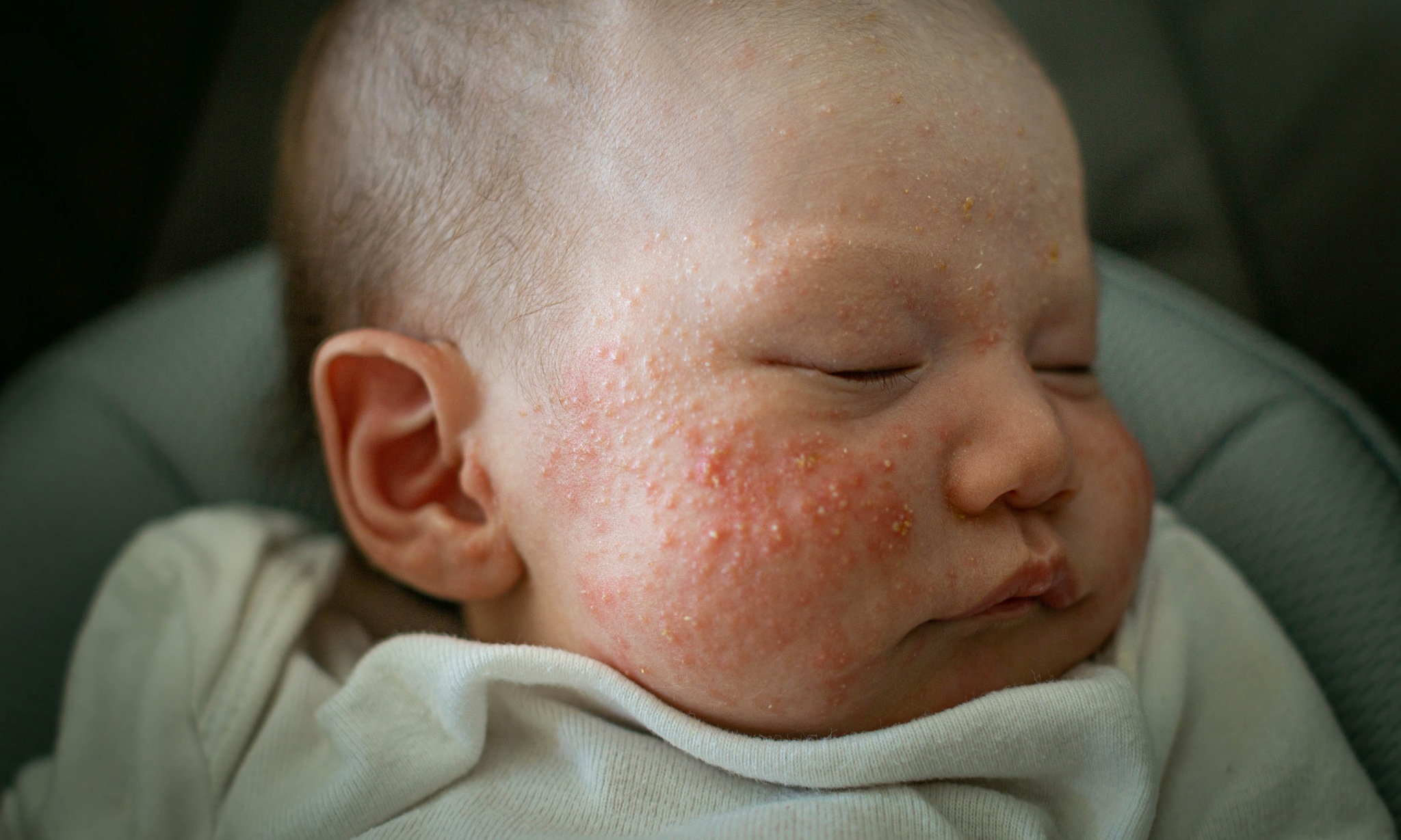 Eczeem bij je baby Getty Images