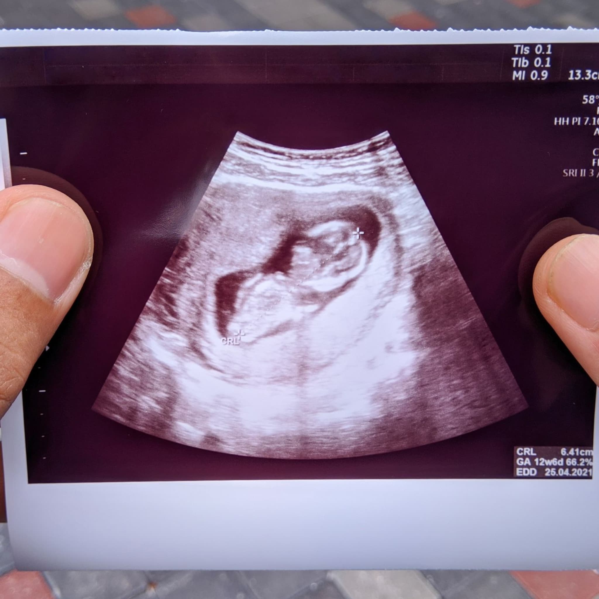 nekplooimeting bij je baby