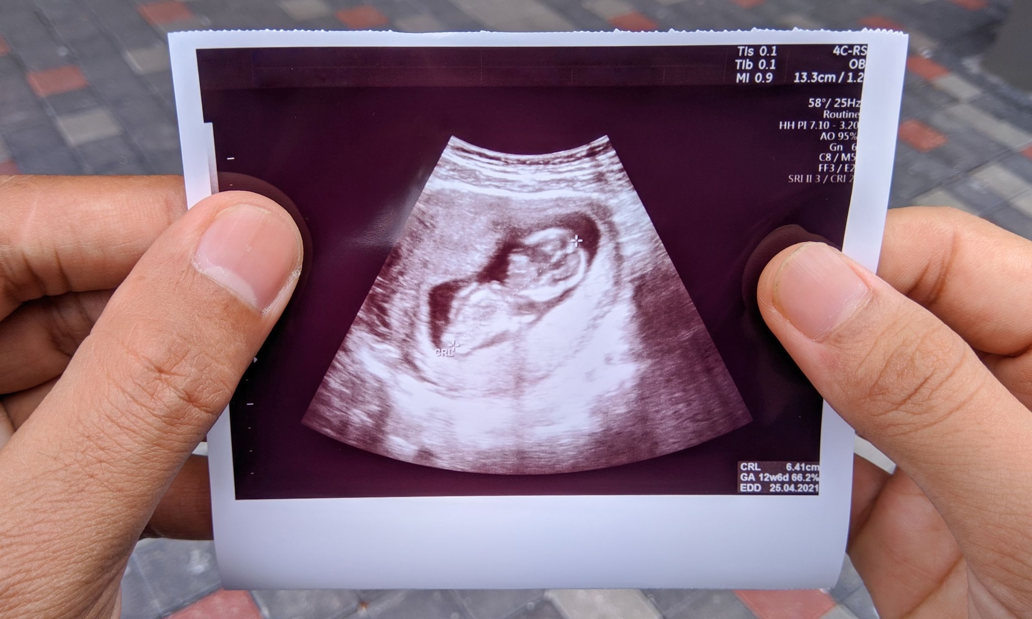Nekplooimeting bij je baby Getty Images