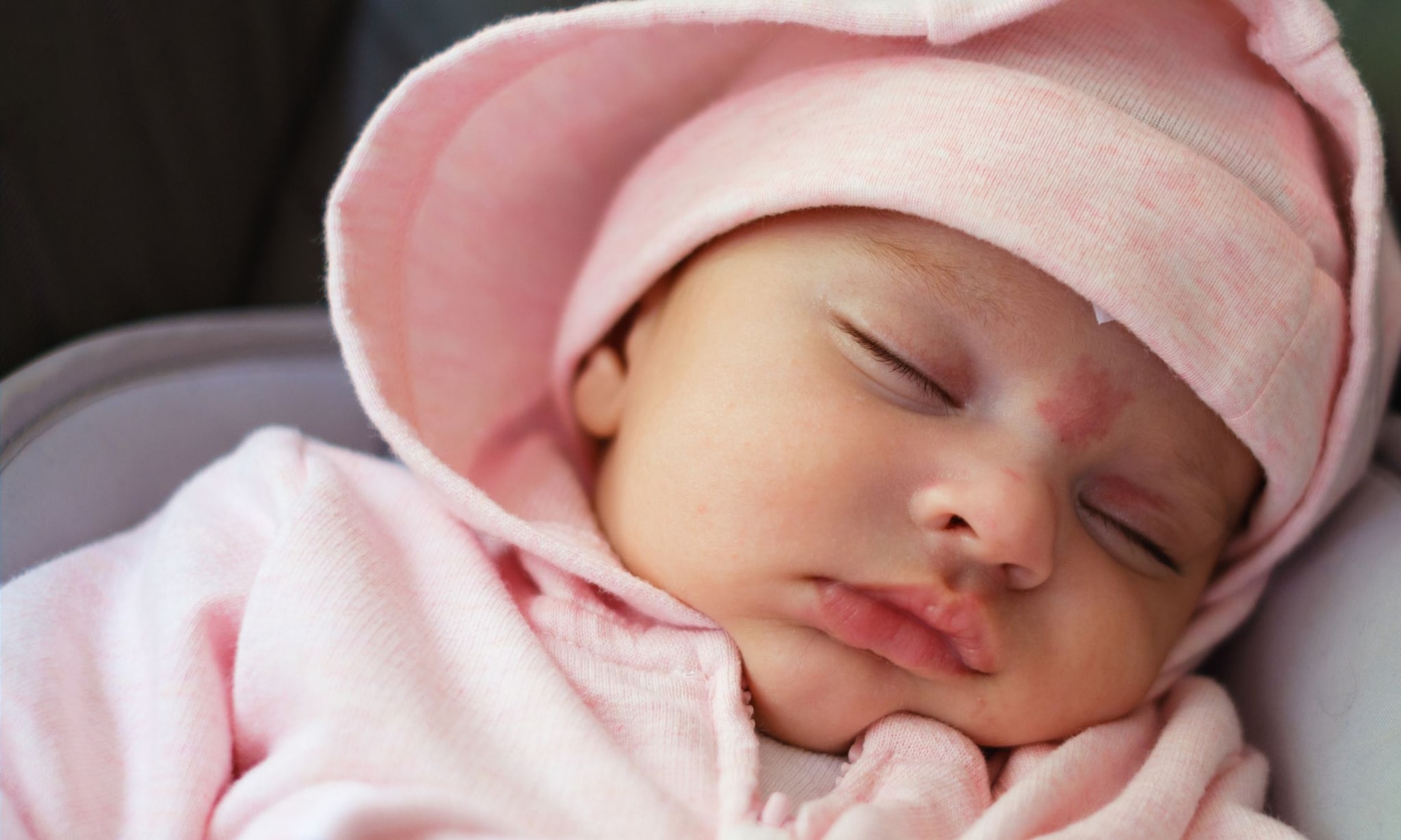 Geboortevlekken bij baby’s Getty Images
