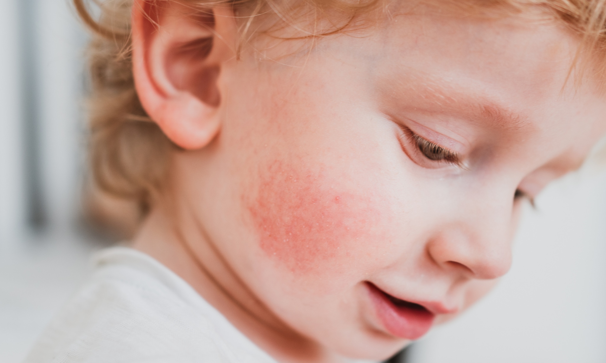 Allergische reactie bij je kind Getty Images