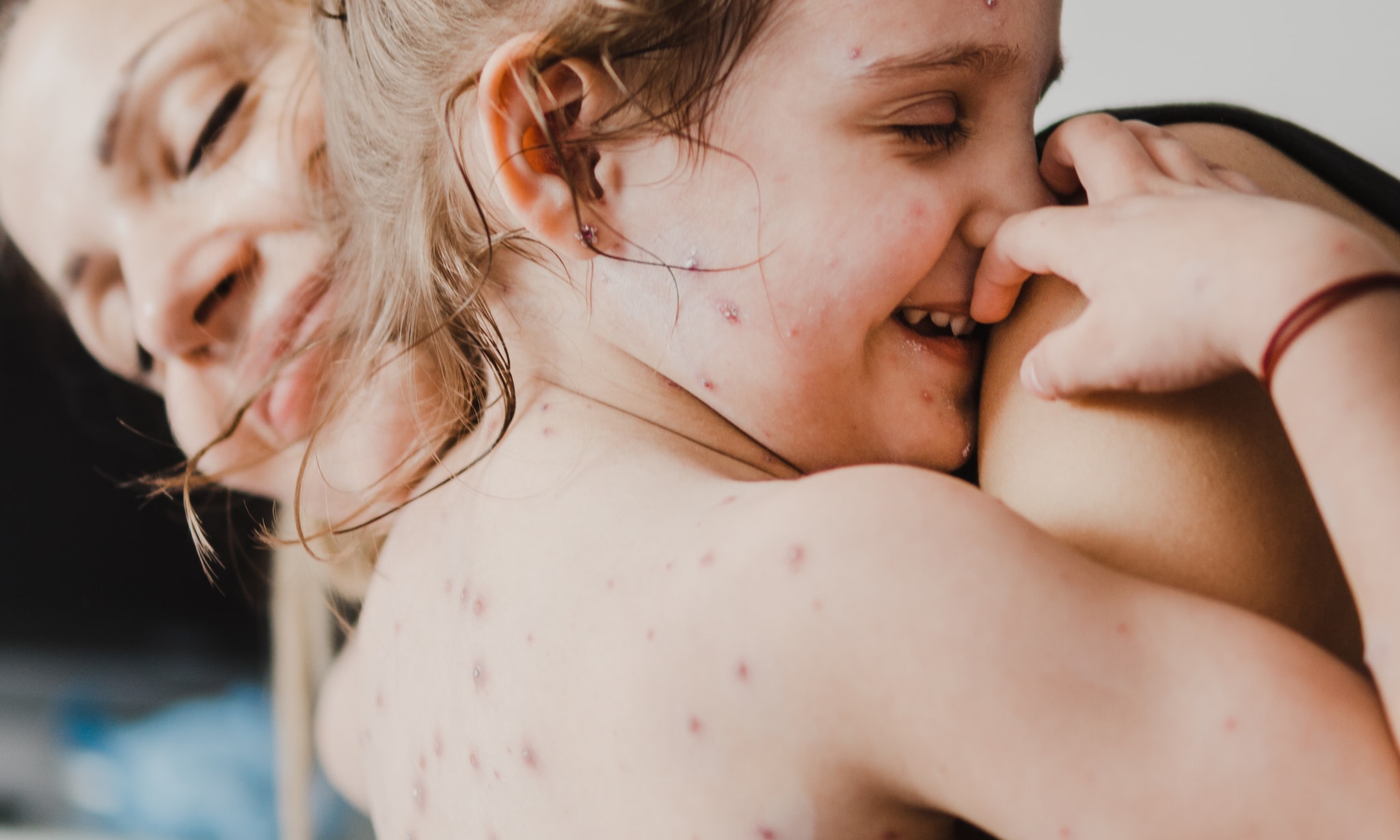 Waterpokken bij je baby en kind wat te doen