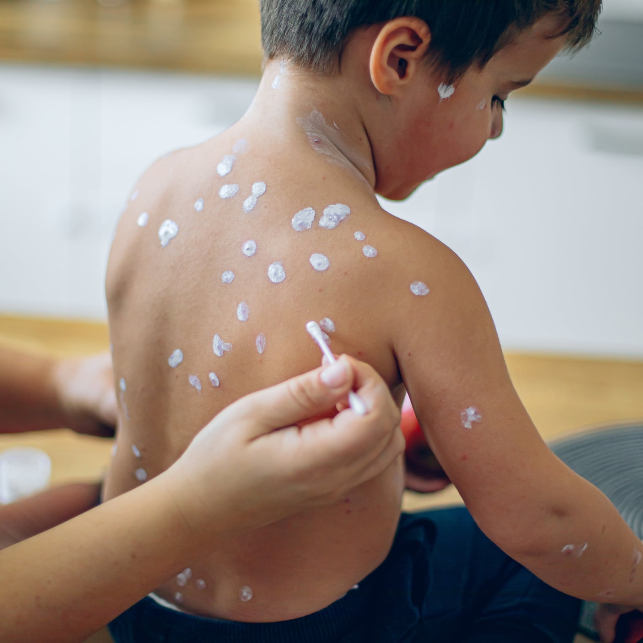waarom krijgen kinderen geen vaccin tegen waterpokken