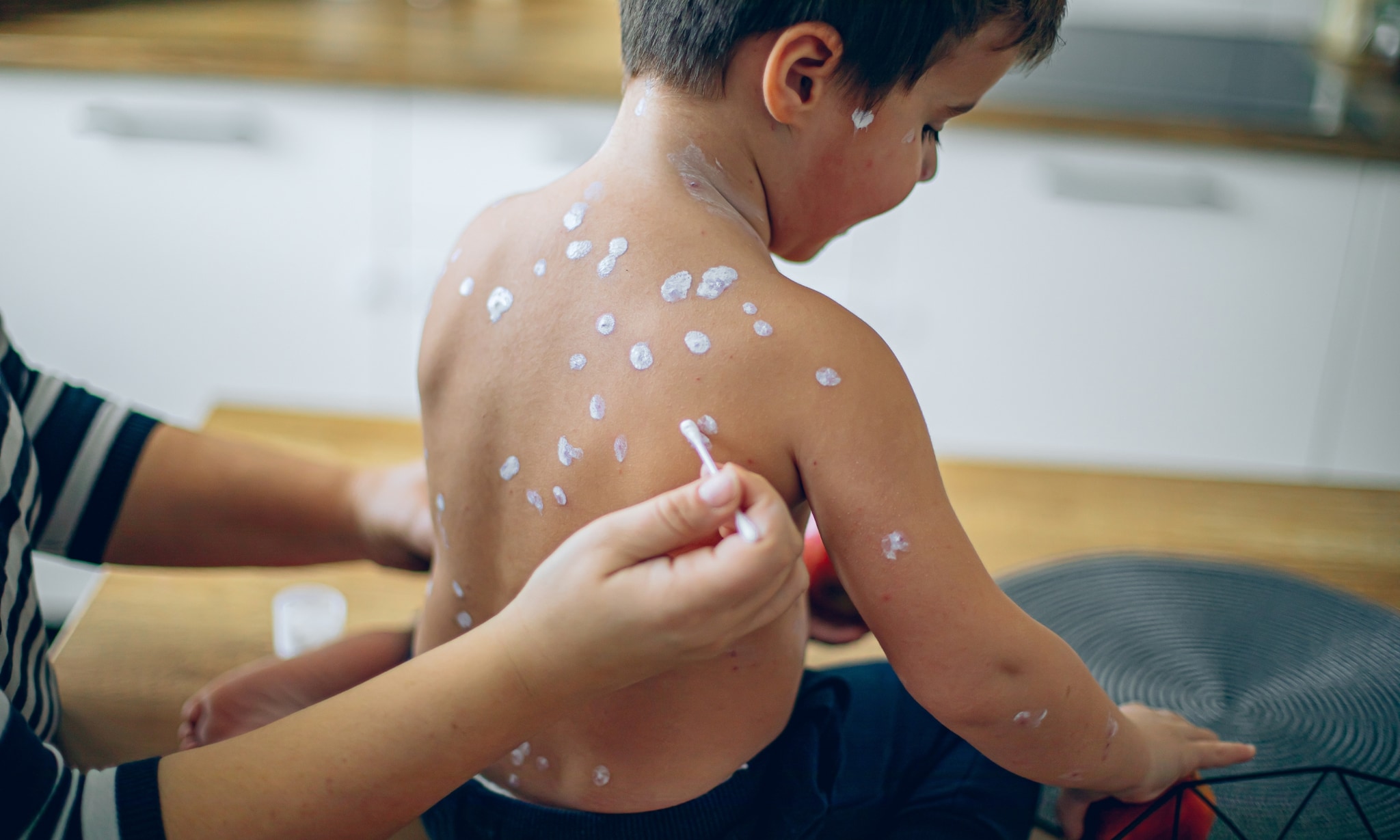 Kind met waterpokken wordt verzorgd door ouder. Getty Images