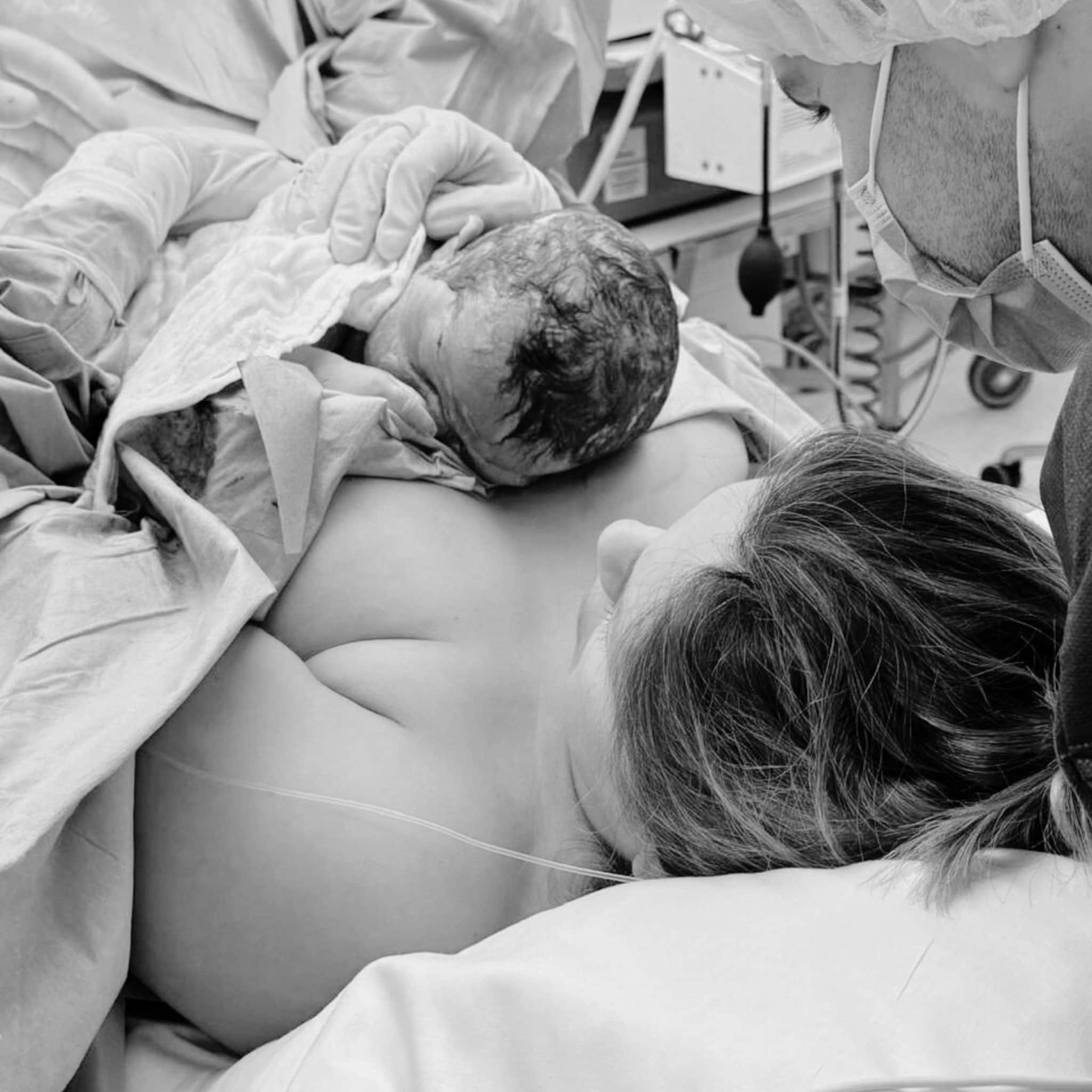 bevallingsverhaal michelle moeder geassisteerde keizersnede